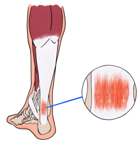 tendinopathy - tendon pathology