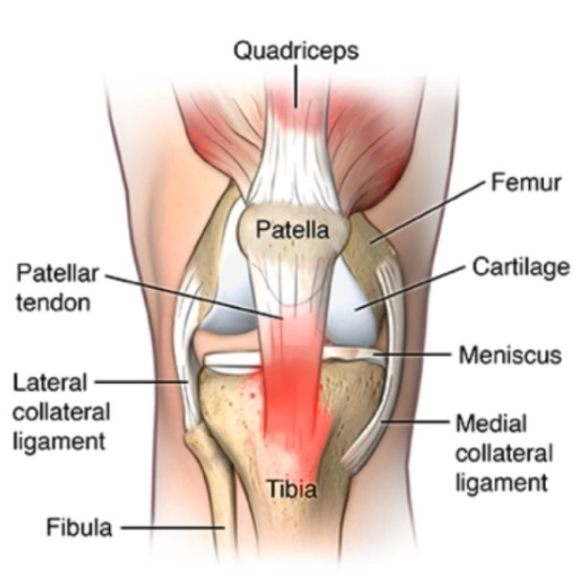 tendinopathy pain